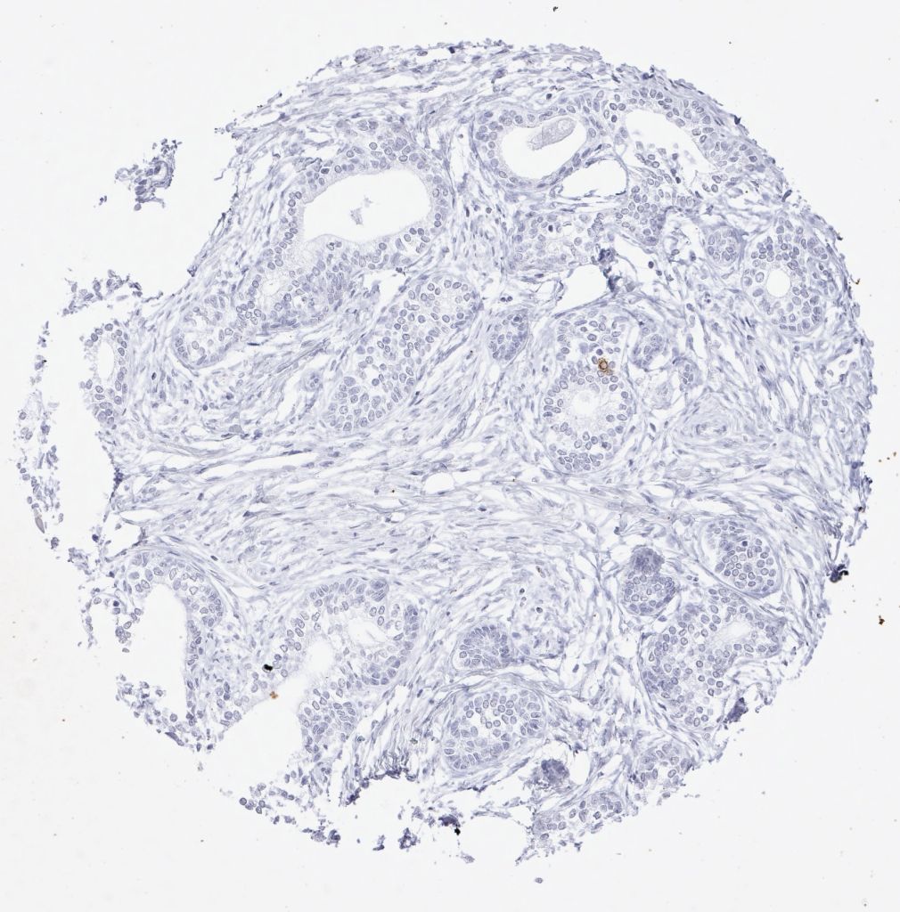 Fig.04 prostate - loss of PSA staining