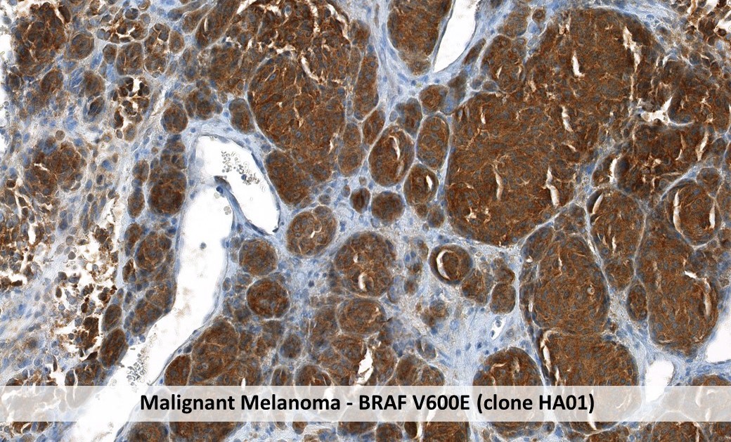 Immunohistochemistry Melanoma with BRAVV600E clone HA01 in formalin-fixed paraffin-embedded tissue