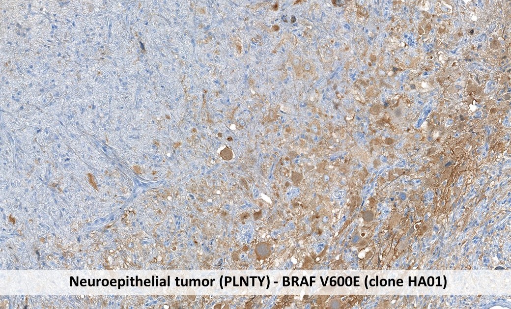 Immunohistochemistry Neuroepithelial tumor (PLNTY) with BRAVV600E clone HA01 in formalin-fixed paraffin-embedded tissue