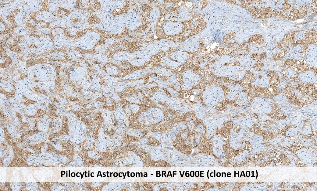 Immunhistochemie pilozytisches Astrozytom anti-BRAFV600E Antikörper (Klon HA01)