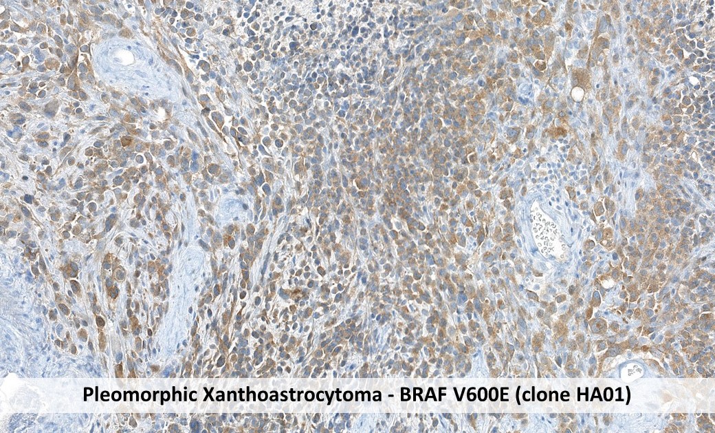 Immunhistochemie pleomorphes Xanthoastrozytom mit anti-BRAFV600E Antikörper (Klon HA01)