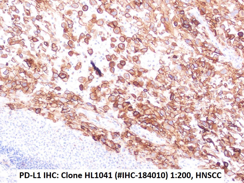 Immunohistochemie mit anti-PD-L1 Klon HL1041 in HNSCC Schnitt (FFPE)