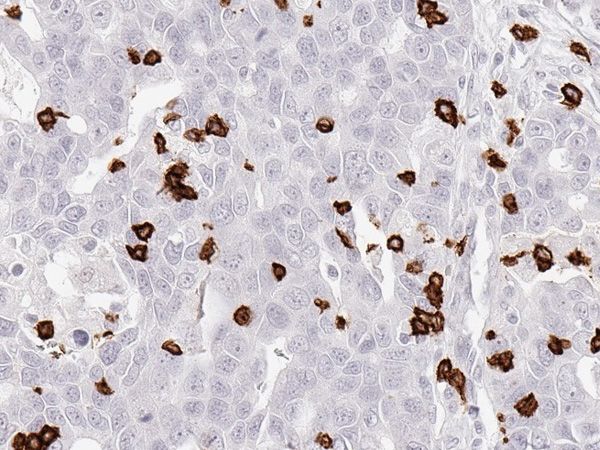 CD8_Ovary-carcinoma