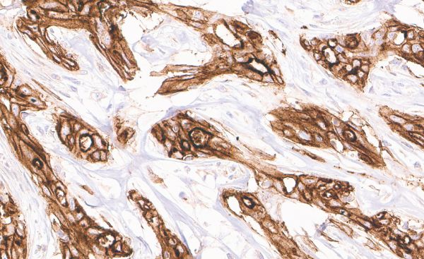 Strong homogeneous CD73 immunostaining in a cholangiocellular carcinoma of the liver.