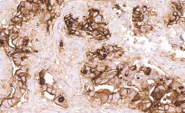Membranous CD73 immunostaining in an adenocarcinoma of the lung shows apical predominance.