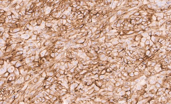 Prominent membranous CD73 positivity in a malignant melanoma.