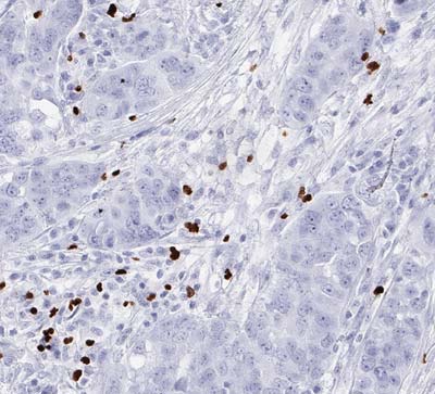 Fig.04 IHC detection of FOXP3-positive TILs in Ovarian Ca, (40x)
