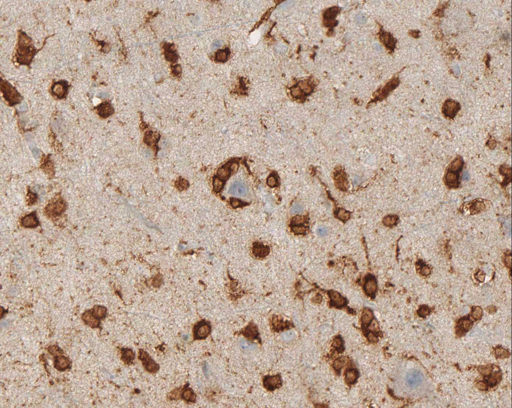 Cortex infiltrated by oligodendroglioma with specific labelling of tumor cells by antibody clone H09.