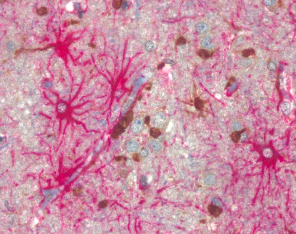 Double staining of GFAP (glial fibrillary acidic protein, red) and clone H09 (brown) of oligodendroglioma infiltration zone demonstrating specific labelling of tumor cells but not of GFAP positive reactive astrocytes.