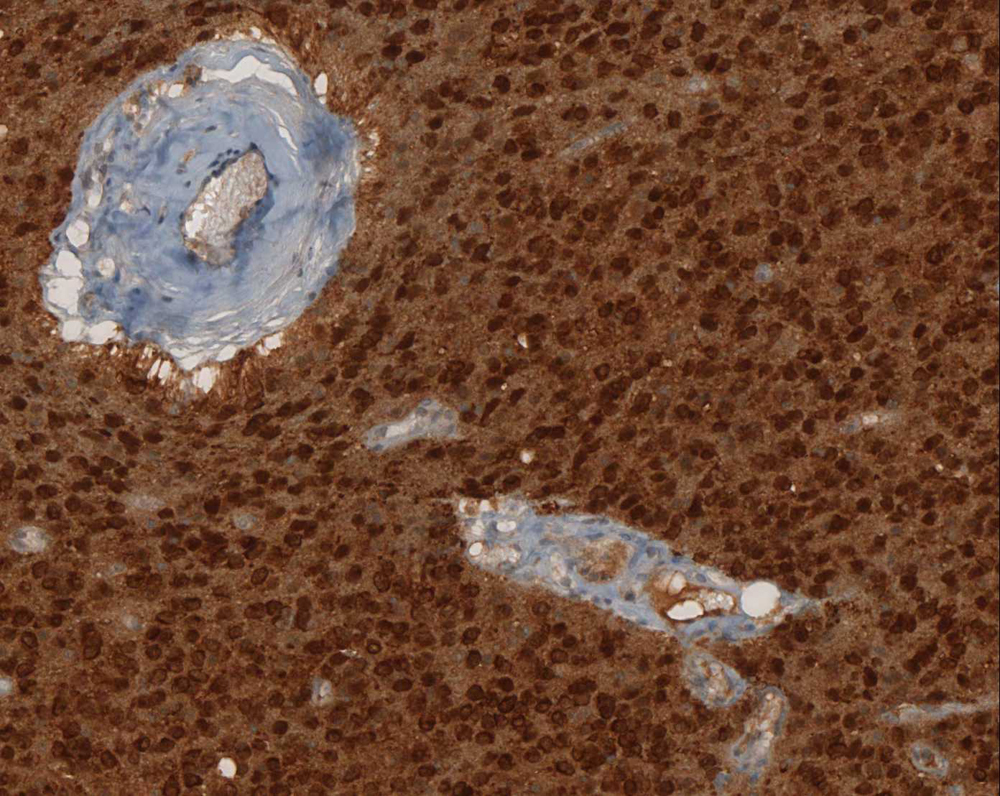 Immunohistochemical staining (IHC) with anti-IDH1 R132H Antibody (clone H09) - dianova
