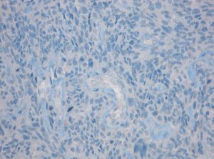 No reaction of IDH1 R132H mutation specific antibody clone H09 with glioblastoma
