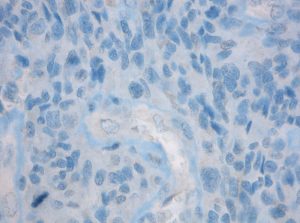 No reaction of IDH1 R132H mutation specific antibody clone H09 with glioblastoma. Enlarged view 400x