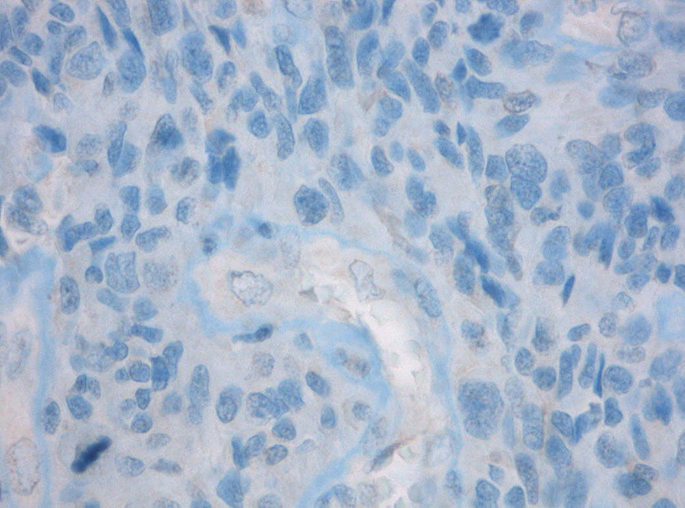 Immunohistochemical staining (IHC) with anti-IDH1 Antibody (clone W09) - dianova