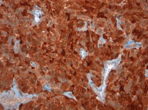 But strong reaction of anti-pan-IDH1 specific antibody cloneW09 with the same glioblastoma.