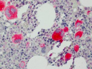 Immunohistochemical staining (IHC) with anti-mutated CALR Antibody (clone CAL2) - dianova