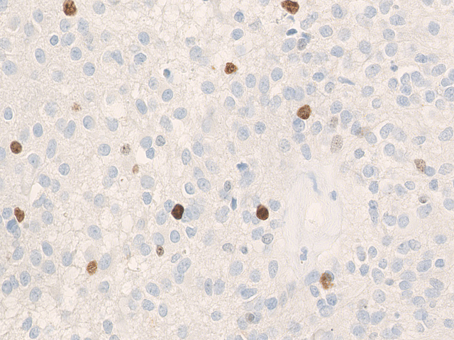 Immunohistochemical staining (IHC) with anti-Ki-67/MIB1 Antibody (clone Ki-67P) - dianova